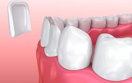Gülüş Tasarımında Devrim Yaratan Yöntem Porselen Lamine